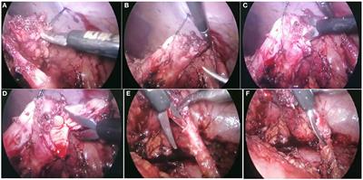 Redo laparoscopic pyeloplasty for recurrent ureteropelvic junction obstruction: Propensity score matched analyses of a high-volume center